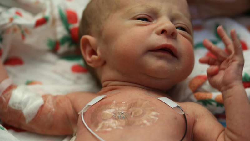 Adhesive Burden in NICU Monitoring